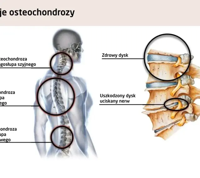 Anatomia kręgosłupa: osteochondroza szyjna może powodować zawroty głowy. Pokazano zdrowy i uszkodzony dysk uciskający nerw.