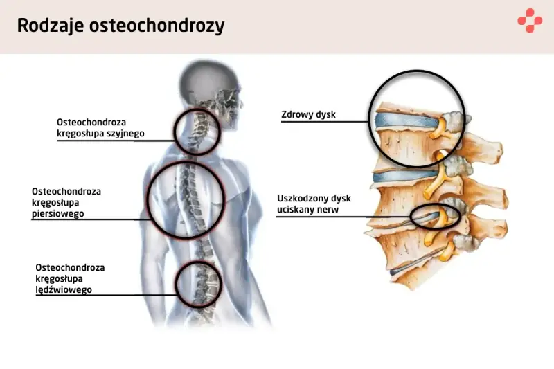 Anatomia kręgosłupa: osteochondroza szyjna może powodować zawroty głowy. Pokazano zdrowy i uszkodzony dysk uciskający nerw.